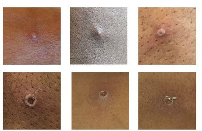 Examples of Monkeypox Rash