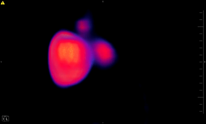 Animated image of PET/CT showing heart only